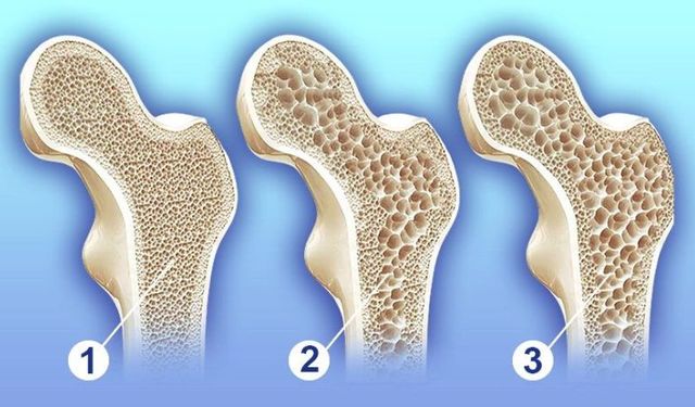 Kemik erimesi tanısı olanlar dikkat! Bu besinler ağrıları dindiriyor, belirtileri hafifletiyor