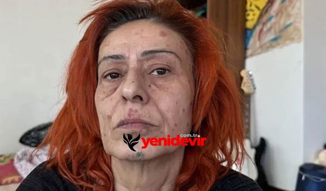 Yıldız Tilbe’nin yüzündeki izler endişelendirdi! Ne oldu?